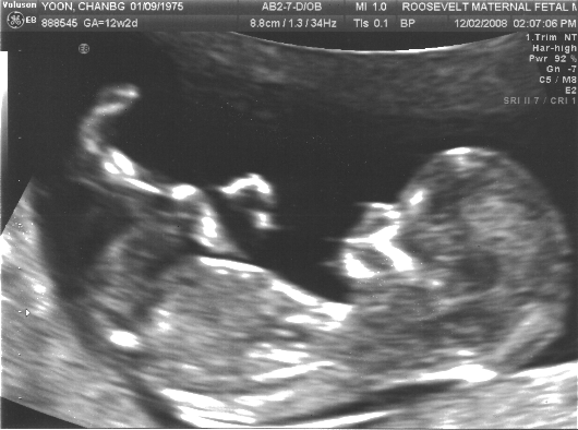 ultrasound_20081202_chillin