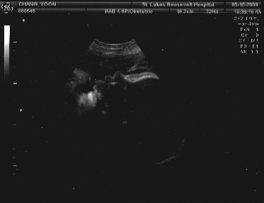 ultrasound_20090515_big-lips