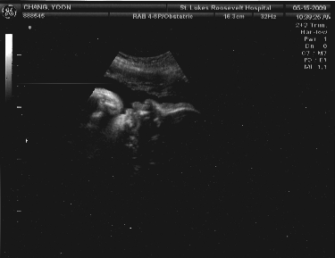 ultrasound_20090515_the-thinker